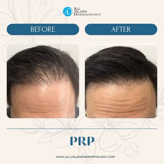 PRP Results: Notice the difference in density! 💉✨

This patient saw a visible improvement in hair f