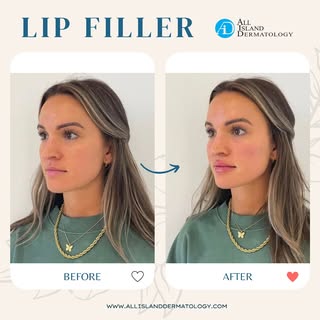 Before & After: Lip Filler 💉

Our beautiful patient wanted a fuller, more defined pout—and the resu