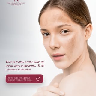 Melasma não some com qualquer creme. E se você já tentou clareador atrás de clareador sem resultado 