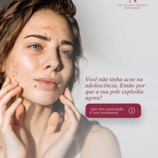 Você passou a adolescência inteira sem acne. Pele limpa, zero problema. Agora, com 25, 30 ou 35 anos