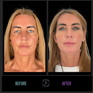 👁️‍🗨️ Upper Eyelid Transformation 👁️‍🗨️

Swipe ➡️ to see our patient’s rejuvenation 2 years foll