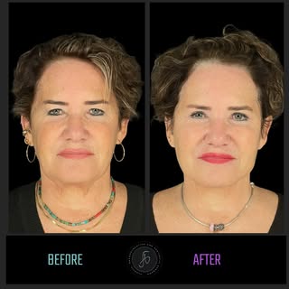 Can thread lifting be an alternative to face and neck lifting?
The answer is no! 
✅However, for thos