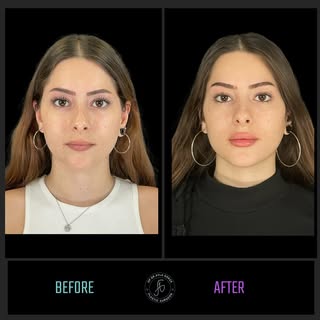 👄 Lip Magic 🪄

Swipe ➡️ to see the subtle, yet amazing change of our patient. 

✅ Lip filler: Enha