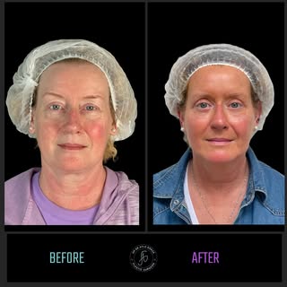 🪄 Facial rejuvenation combination 🪄 

Swipe ➡️ to see the subtle, yet a fascinating transformation