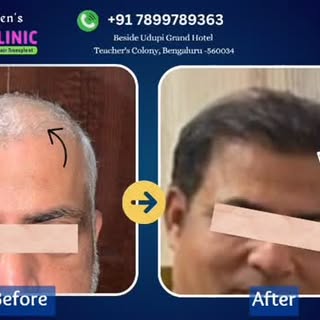 #fuehairtransplant 
“Say goodbye to hair loss and hello to a fuller head of hair! The procedure is s