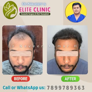 #hairtransplant