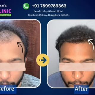 FUE Hair Transplant 

Are you tired of hair loss? Want to restore your confidence with a natural-loo