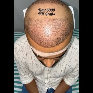 *FUE Hair Transplant*

Are you tired of hair loss? Want to restore your confidence with a natural-lo