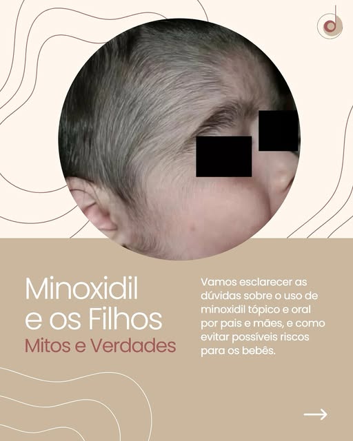 Você sabia que o uso do minoxidil tópico pelos pais pode exigir cuidados para proteger os bebês? Rec
