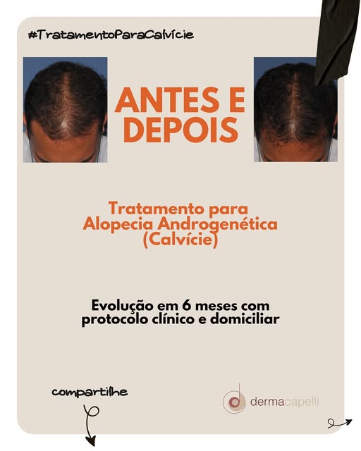 🔍 Resultados reais, baseados em ciência!
Esse paciente iniciou o tratamento para Alopecia Androgené