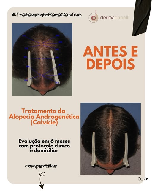 🔍 𝗥𝗲𝘀𝘂𝗹𝘁𝗮𝗱𝗼𝘀 𝗿𝗲𝗮𝗶𝘀, 𝗲𝗺 𝗮𝗽𝗲𝗻𝗮𝘀 𝟲 𝗺𝗲𝘀𝗲𝘀!

Esse paciente iniciou o tratam