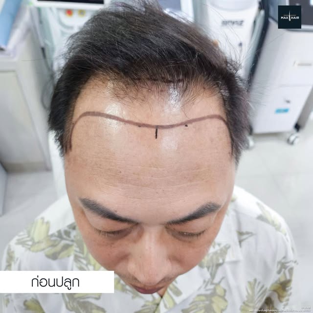ก่อนหน้านี้คนไข้ไม่ค่อยมั่นใจกับทรงผมของตัวเอง เพราะรู้สึกว่าบริเวณด้านหน้าดูบางลงเรื่อย ๆ เวลาจัดทร