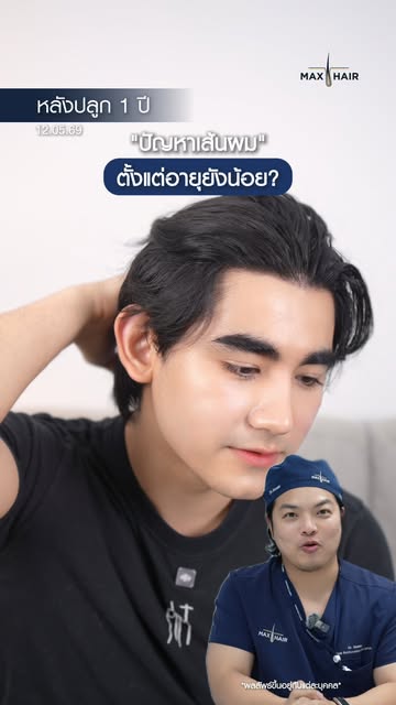 อายุน้อยปลูกผมได้ไหม ? [ เดรก สัตบุตร - ศิลปินนักแสดง ] เคสนี้ปลูกด้วยเทคนิค Non Shaven หลังปลูกผมไป