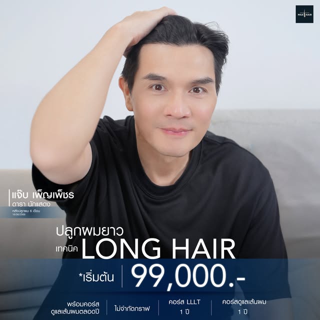 ปลูกผมแบบไม่ต้องโกน ด้วยเทคนิค Long Hair เติมไรผม ปรับกรอบหน้า ให้ชัดขึ้น
[ แจ๊บ เพ็ญเพ็ชร - ดารานัก