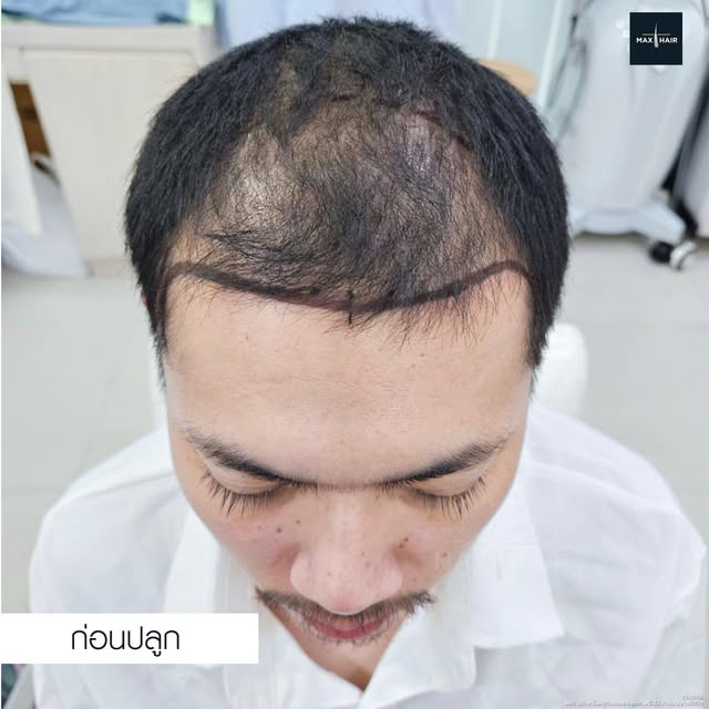 หลังจากเริ่มสังเกตว่าผมบางลงมากขึ้นเรื่อย ๆ การจัดแต่งทรงผมที่เคยทำได้ง่ายก็เริ่มไม่เหมือนเดิม จึงตั