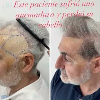 En nuestra clínica realizamos trasplantes capilares de forma gratuita a pacientes con cicatrices por