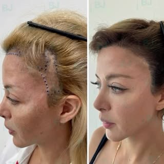 Cicatriz tras lifting facial tratada con trasplante capilar.
Un resultado definitivo y natural, dond