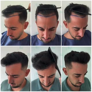 ✨ Técnica FUE: ¡Resultados increíbles y paciente feliz! 🙂 
¿Quieres ver más resultados como este? �