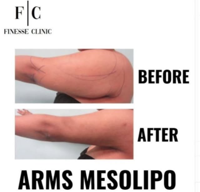 📍ARMS FAT MELTING📍

✨What is a Mesolipo?
Mesolipo injections, also known as fat-dissolving injecti