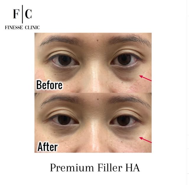 💧 FILLER 💧

🌸Dermal fillers are gel-like substances that are injected beneath the skin to restore