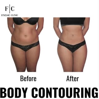 💃BODY CONTOURING 💃

✨What is a Mesolipo?
Mesolipo – Lipo Dissolve (For Fat and Cellulite Reduction