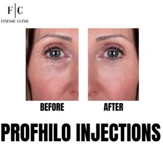 🌹 PROFHILO 🌹

🌸 Is Profhilo good for décolletage?
Profhilo is ideal for treating areas that have 