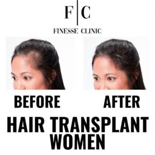 🚺 HAIR TRANSPLANT WOMEN 🚺

📒 What Is a Hair Transplant?
Hair transplantation is a surgical techni