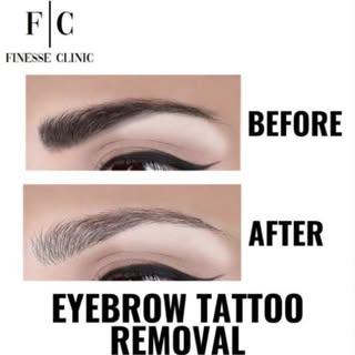 🪷 EYEBROW TATTOO REMOVAL 🪷

How does tattoo ink stay in the skin?
💥 The epidermal layer of skin, 