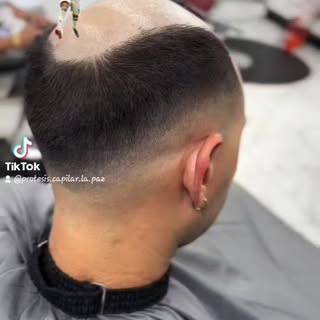 ¿Qué diferencia hay entre una peluca y una prótesis capilar?
Las pelucas cubren cabeza entera mientr