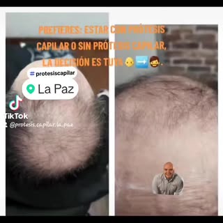 Son muchas las ventajas de usar una prótesis capilar:
✅ Es un reemplazo capilar para poner y sacar, 