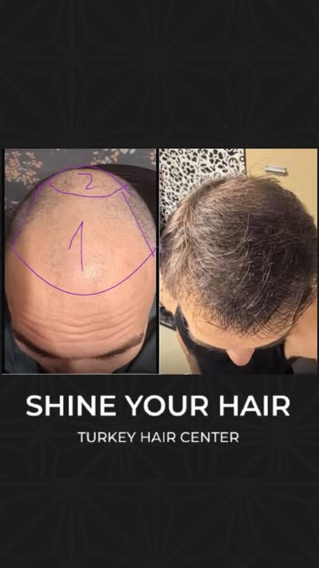 Лысина? Хватит переживать! 😎
Пересадка волос в Shine Your Hair — и ты снова с волосами.
📩 Пиши в д