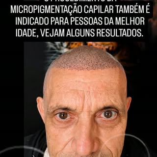 Queda extrema de cabelo, calvície avançado ou falha capilar com o procedimento da micropigmentação c