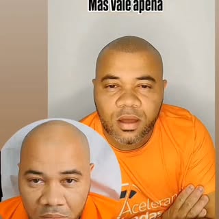 Micropigmentação Capilar procedimento estético masculino para calvície extrema.
