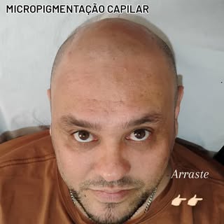 Solução imediata para queda de cabelo 
.
.
.
Sem área doadora 
.
.
.
Rápido, eficaz e bom custo bene
