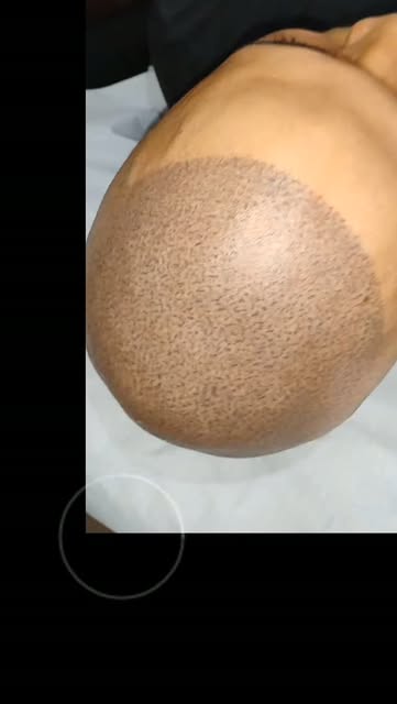 Chega de sofrer por causa da calvície esse procedimento resolve mesmo. Micropigmentação Capilar em S