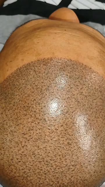 Condições especiais para calvície extrema 
Micropigmentação capilar 
Studio fica no centro de Soroca