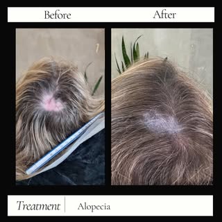 🌟 Alopecia Scarring Repair 🌟

Struggling with alopecia scars? You’re not alone, and I'm here to he