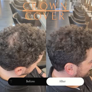 👑 Crown Restored. Confidence Reignited. 👑
This before & after says it all — a subtle, natural fill