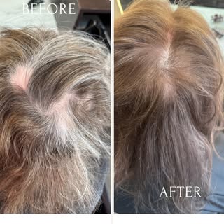 ✨ From self-conscious to confident — this is the power of SMP. ✨
⁣
Alopecia can impact more than jus