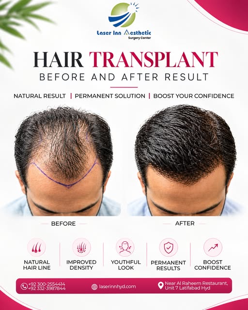Hair Transplant — A New Look, A New Confidence ✨

Struggling with hair loss or a receding hairline? 