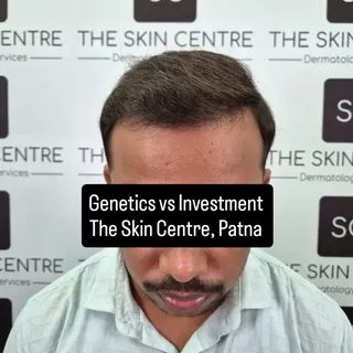 Genetics vs Investment. ( The Skin Centre, Patna 
 Hairline is not a line alone. The placement and s