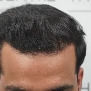 Creation of perfect hairline through Hair Transplant.
Regards 
Dr Abhinav Kumar 
The Skin Centre, Pa