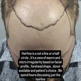 Hairline designing in Hair Transplant 
 
It's not a circle , it's not a patterned zig zag , it's not