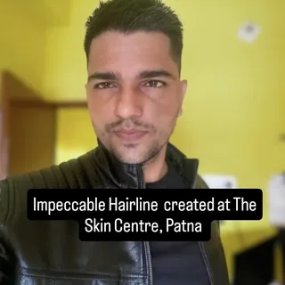 A world class hair transplant requires precision, skill, time and due efforts. These are not easy to