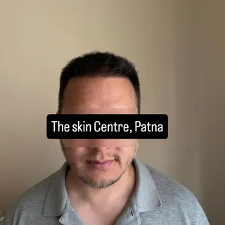 No wonders ,The Skin Centre, Patna is able to pull patients from across the globe for our unique cus
