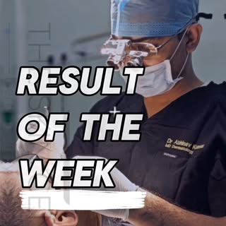 American Patient Hair Transplant in Patna. Amazing Transformation of Patient at The Skin Centre afte