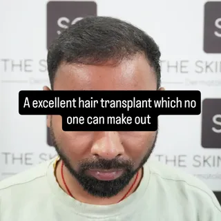 A good Hair hair transplant is one which noone can make out.
 It requires correct positioning of hai