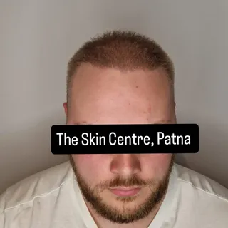 Poland to Patna for Hair Transplant and our quality of work speaks for itself in pictures.
Regards 
