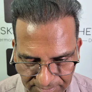From Norwood 7 hair loss to a fuller head with magical transformation- Story of magical transformati
