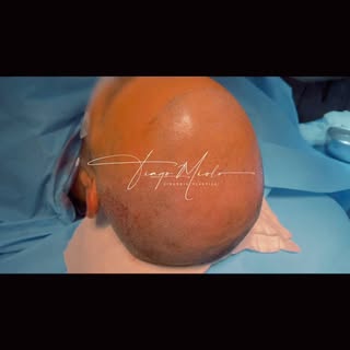 Nosso Amigo Davi Augusto mais feliz, nascerão cerca de 10 mil fios que foram implantados. Diz ai se 